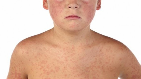 加国新增麻疹病例引关注 孩童须注意 | 新闻